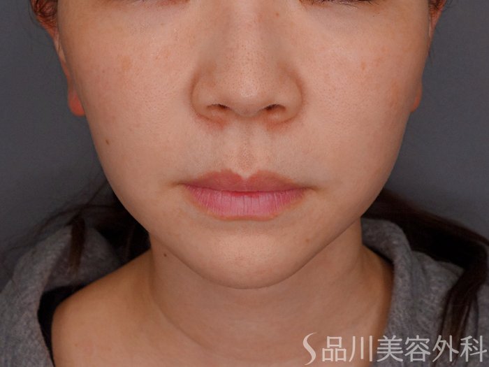 症例NO.74329のBEFORE写真