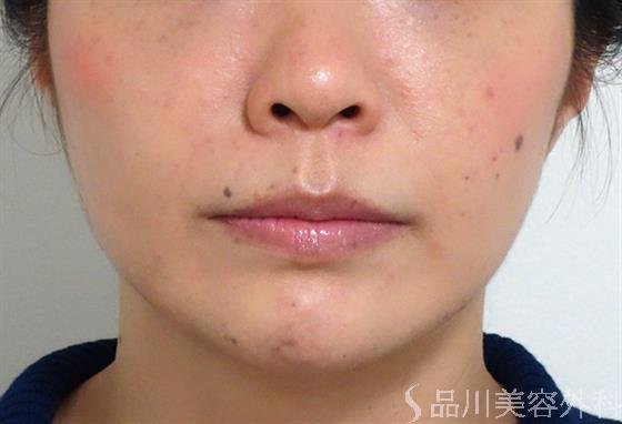 症例NO.35800のAFTER写真