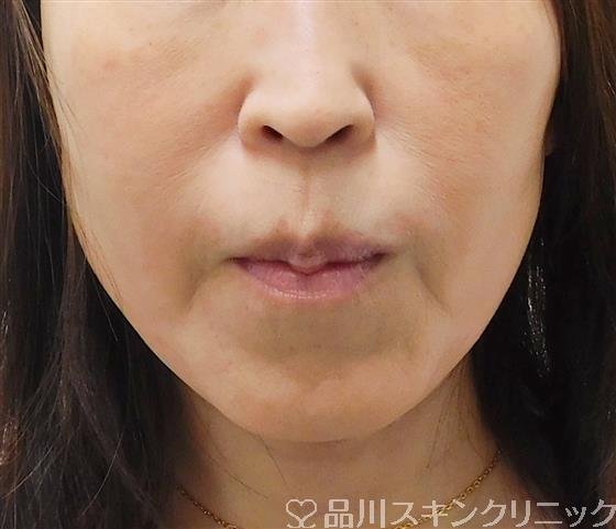 症例NO.54169のAFTER写真