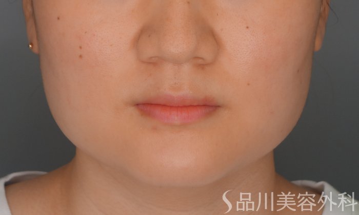 症例NO.70108のBEFORE写真