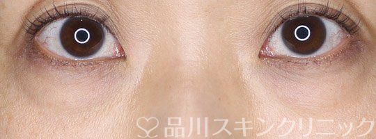 症例NO.74010のBEFORE写真
