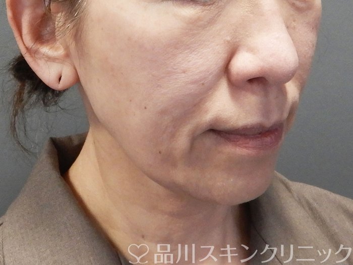 症例NO.73575のBEFORE写真