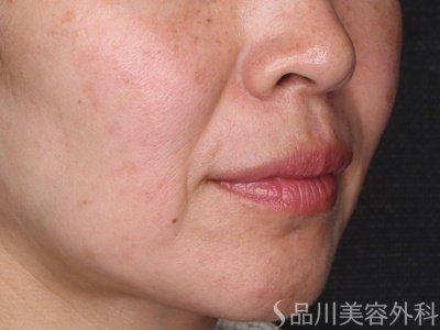 症例NO.75304のBEFORE写真