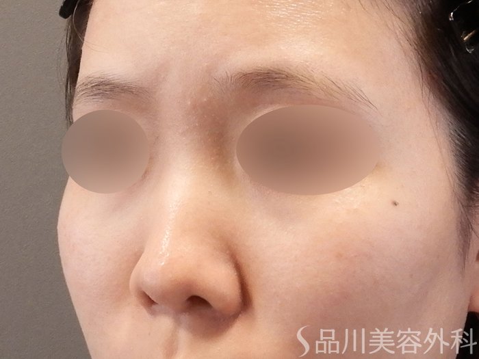 症例NO.65232のBEFORE写真