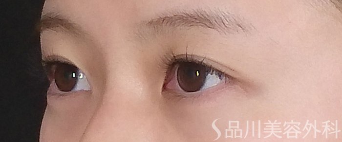 症例NO.69236のBEFORE写真