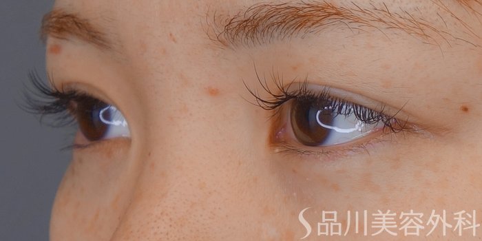 症例NO.66906のBEFORE写真