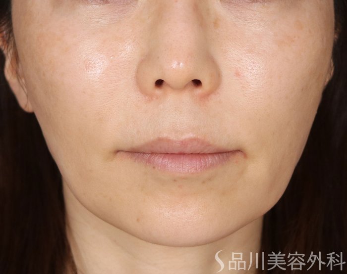 症例NO.74058のBEFORE写真