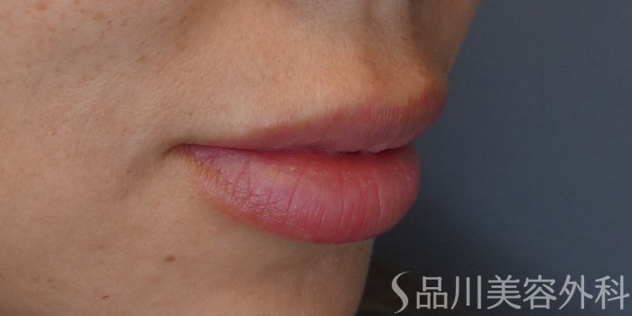 症例NO.67903のAFTER写真