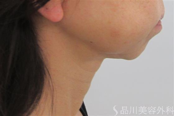 症例NO.32282のAFTER写真