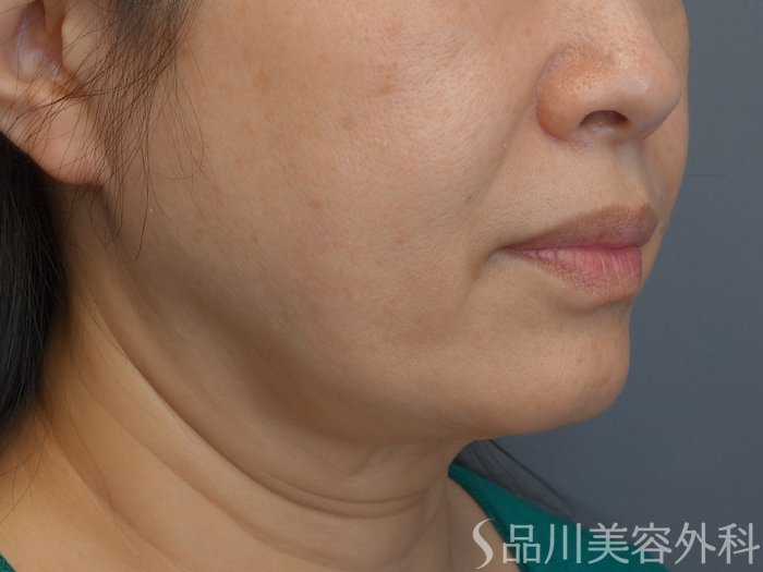 症例NO.72933のBEFORE写真