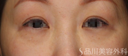 症例NO.64281のBEFORE写真