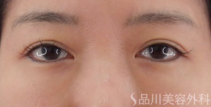 症例NO.62183のAFTER写真
