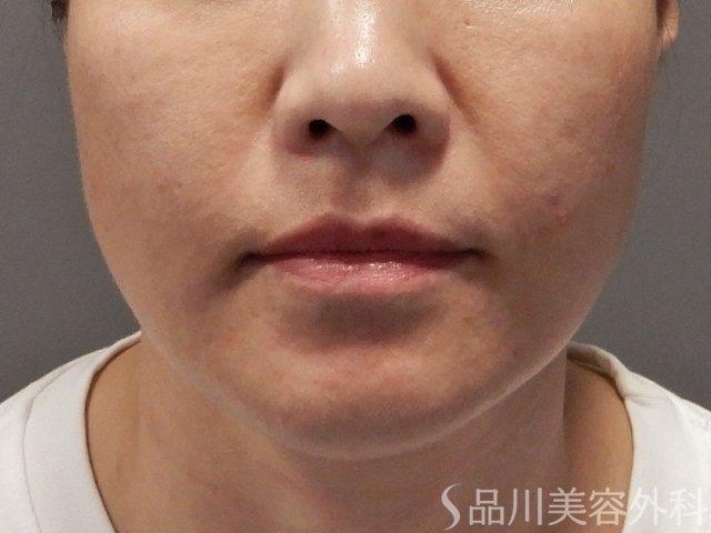 症例NO.71830のBEFORE写真