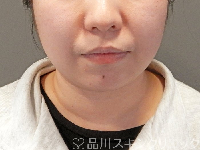 症例NO.64193のBEFORE写真