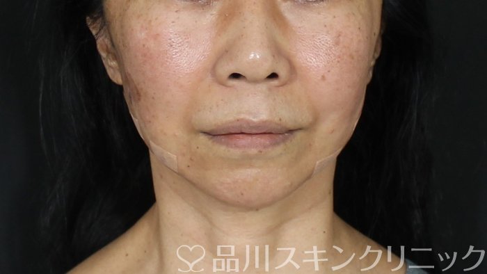 症例NO.72403のAFTER写真