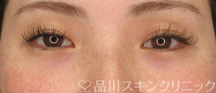 症例NO.69856のBEFORE写真