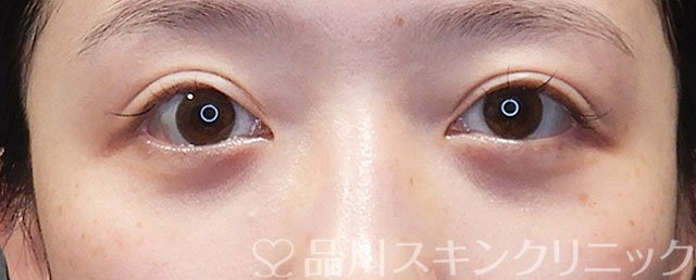 症例NO.71913のAFTER写真