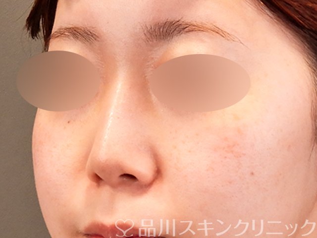 症例NO.69913のAFTER写真