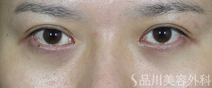 症例NO.71972のAFTER写真