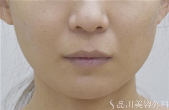 症例NO.47067のAFTER写真