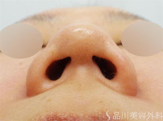 症例NO.46732のBEFORE写真