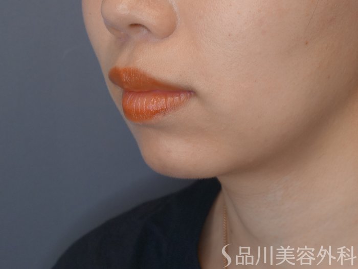 症例NO.71949のBEFORE写真