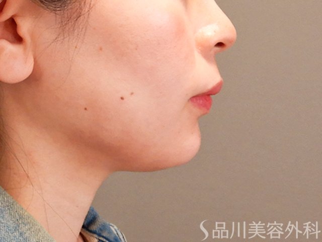 症例NO.69954のAFTER写真