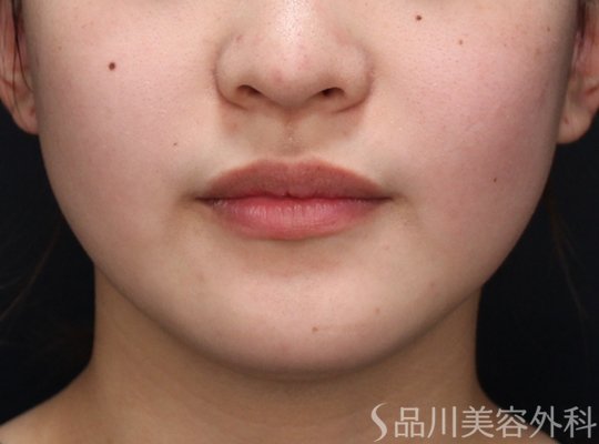 症例NO.73871のBEFORE写真