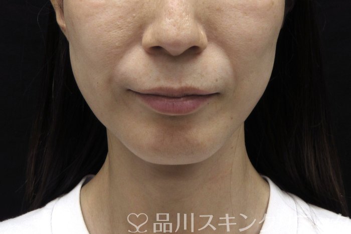症例NO.74475のBEFORE写真