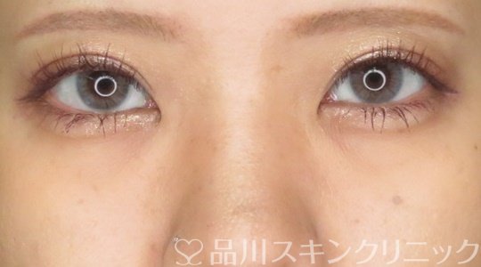 症例NO.70905のAFTER写真