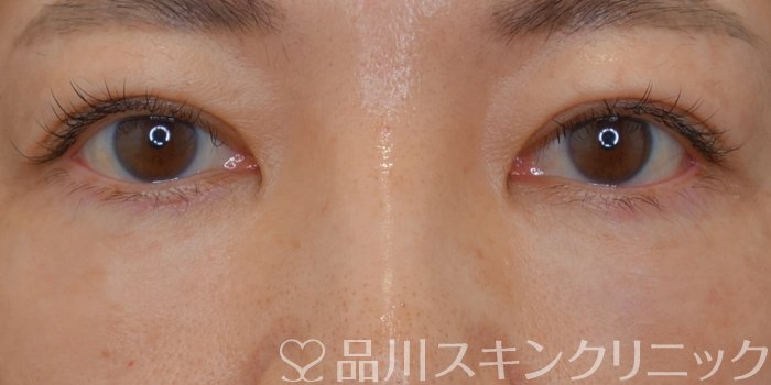 症例NO.72417のAFTER写真