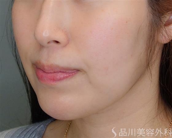 症例NO.50855のBEFORE写真
