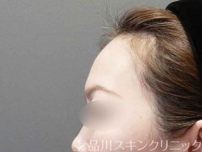 症例NO.73397のBEFORE写真