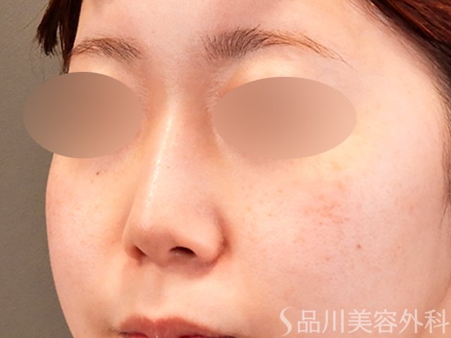 症例NO.69913のAFTER写真