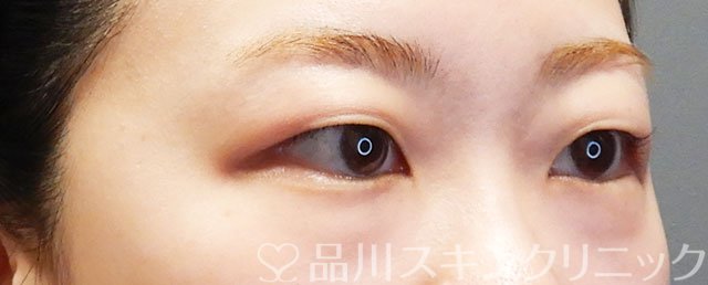 症例NO.75076のBEFORE写真