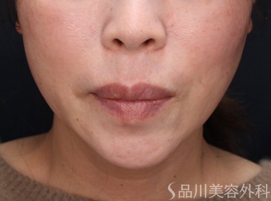 症例NO.73109のAFTER写真