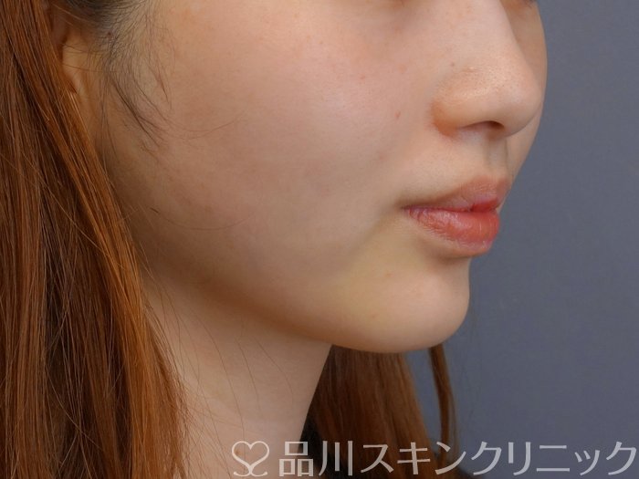 症例NO.74192のAFTER写真