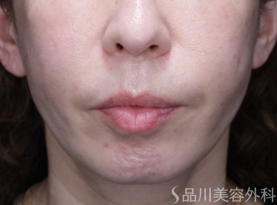 症例NO.73558のAFTER写真