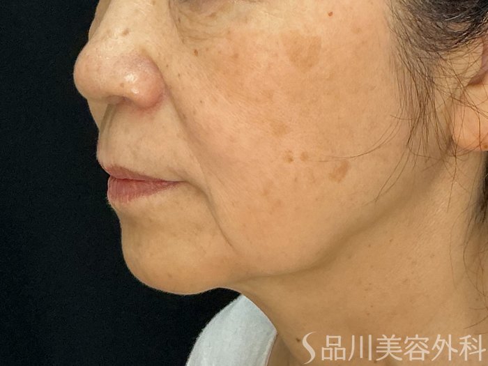 症例NO.71865のBEFORE写真