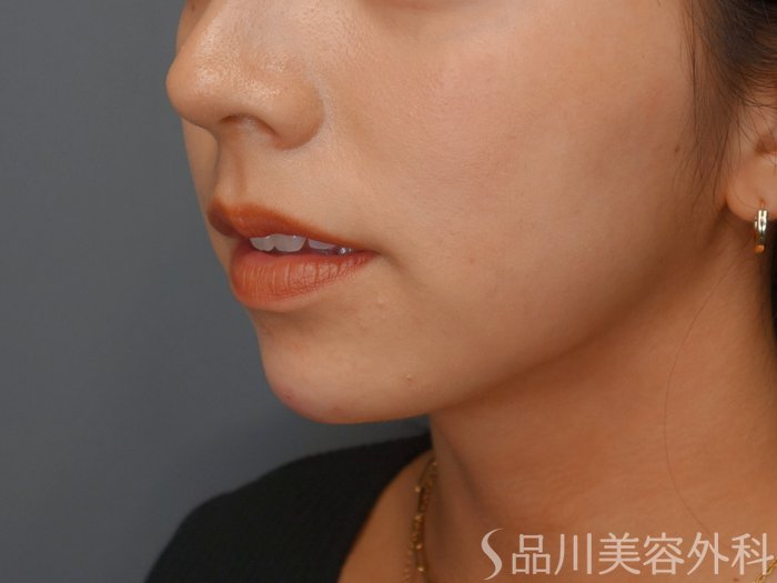 症例NO.74064のAFTER写真