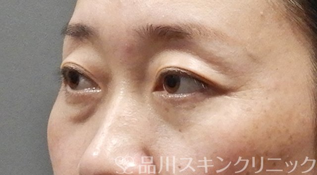 症例NO.64501のBEFORE写真