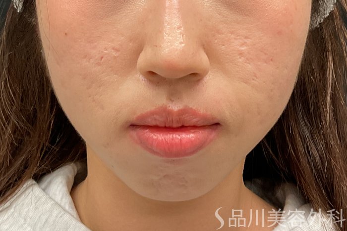 症例NO.73323のBEFORE写真