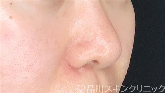 症例NO.60749のAFTER写真