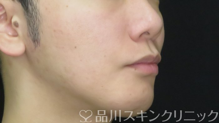 症例NO.71731のAFTER写真