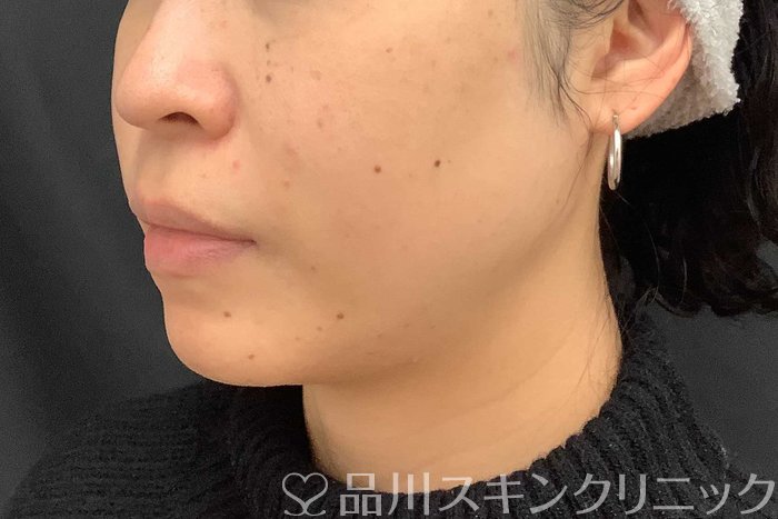 症例NO.69519のAFTER写真