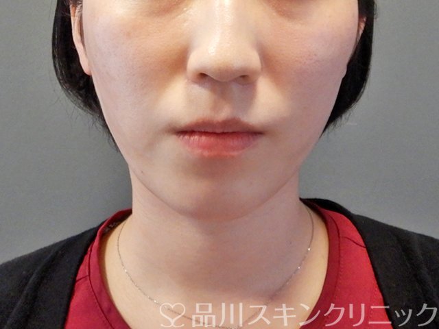 症例NO.67417のAFTER写真