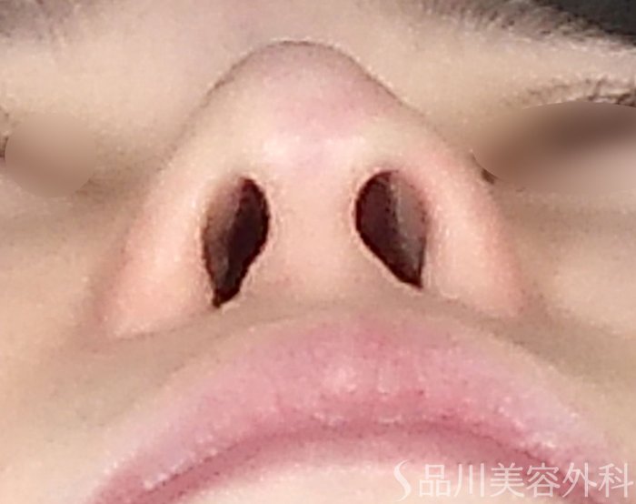 症例NO.64216のAFTER写真