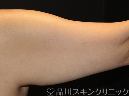 症例NO.67640のAFTER写真