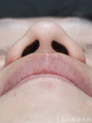 症例NO.75045のAFTER写真
