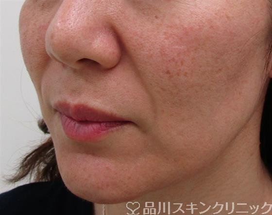 症例NO.34060のBEFORE写真